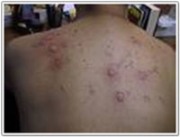 allergy body